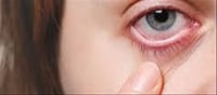Did You Know Your Corneas Can Get Sunburned?